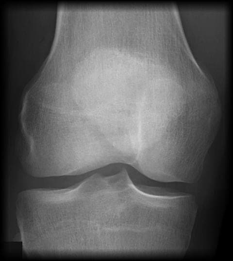 Anteroposterior weight-bearing knee radiograph with AI-generated biomechanical overlay showing joint space width measurement, mechanical axis alignment angles (LDFA, MPTA, FTA), and anatomical landmark detection